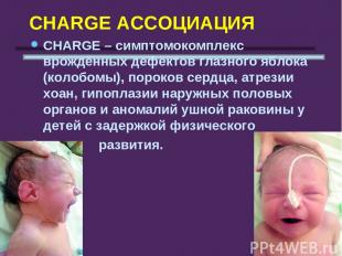 CHARGE АССОЦИАЦИЯ СHARGE – симптомокомплекс врождённых дефектов глазного яблока
