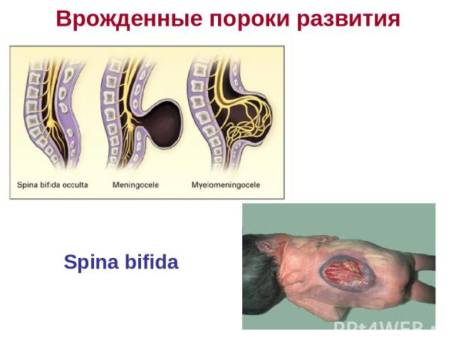 Врожденные пороки развития Spina bifida