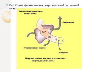 Рис. Схема формирования синусоидальной портальной гипертензии.