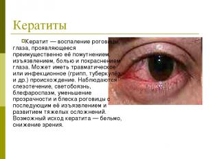 Кератиты Кератит — воспаление роговицы глаза, проявляющееся преимущественно её п