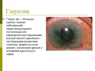 Глаукома Глауко ма — большая группа глазных заболеваний, характеризующаяся посто
