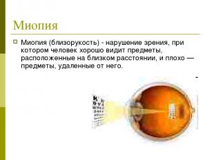 Миопия Миопия (близорукость) - нарушение зрения, при котором человек хорошо види
