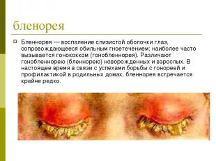 бленорея Бленнорея — воспаление слизистой оболочки глаз, сопровождающееся обильн