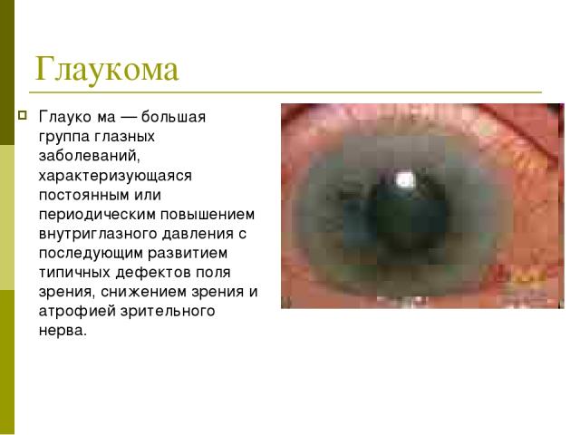 Глаукома Глауко ма — большая группа глазных заболеваний, характеризующаяся постоянным или периодическим повышением внутриглазного давления с последующим развитием типичных дефектов поля зрения, снижением зрения и атрофией зрительного нерва.