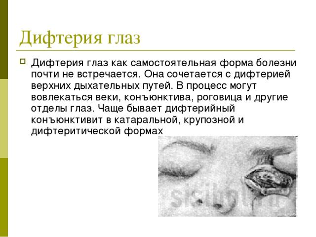 Дифтерия глаз Дифтерия глаз как самостоятельная форма болезни почти не встречается. Она сочетается с дифтерией верхних дыхательных путей. В процесс могут вовлекаться веки, конъюнктива, роговица и другие отделы глаз. Чаще бывает дифтерийный конъюнкти…