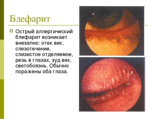 Блефарит Острый аллергический блефарит возникает внезапно: отек век, слезотечение, слизистое отделяемое, резь в глазах, зуд век, светобоязнь. Обычно поражены оба глаза.