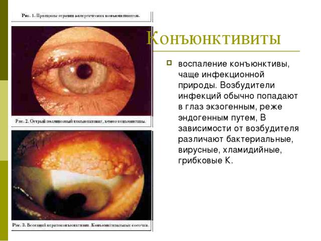 воспаление конъюнктивы, чаще инфекционной природы. Возбудители инфекций обычно попадают в глаз экзогенным, реже эндогенным путем, В зависимости от возбудителя различают бактериальные, вирусные, хламидийные, грибковые К. Конъюнктивиты