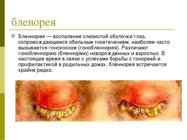 бленорея Бленнорея — воспаление слизистой оболочки глаз, сопровождающееся обильным гноетечением; наиболее часто вызывается гонококком (гонобленнорея). Различают гонобленнорею (бленнорею) новорожденных и взрослых. В настоящее время в связи с успехами…
