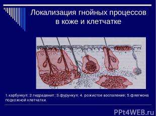 Локализация гнойных процессов в коже и клетчатке 1.карбункул; 2.гидраденит; 3.фу