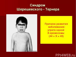 Синдром Шерешевского - Тернера Причина развития заболевания: утрата одной Х-хром