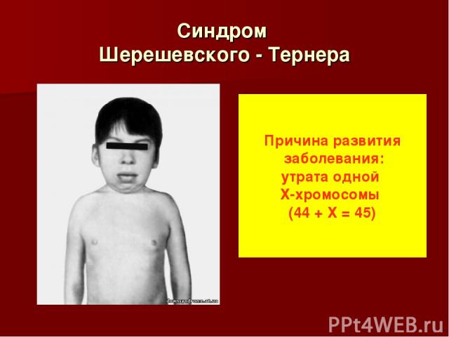 Синдром Шерешевского - Тернера Причина развития заболевания: утрата одной Х-хромосомы (44 + Х = 45)
