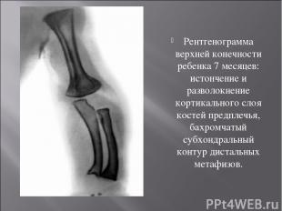 Рентгенограмма верхней конечности ребенка 7 месяцев: истончение и разволокнение