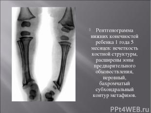 Рентгенограмма нижних конечностей ребенка 1 года 5 месяцев: нечеткость костной с