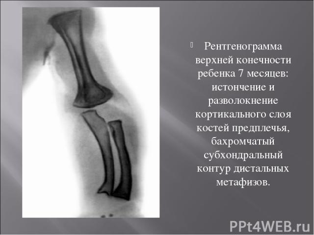Рентгенограмма верхней конечности ребенка 7 месяцев: истончение и разволокнение кортикального слоя костей предплечья, бахромчатый субхондральный контур дистальных метафизов.