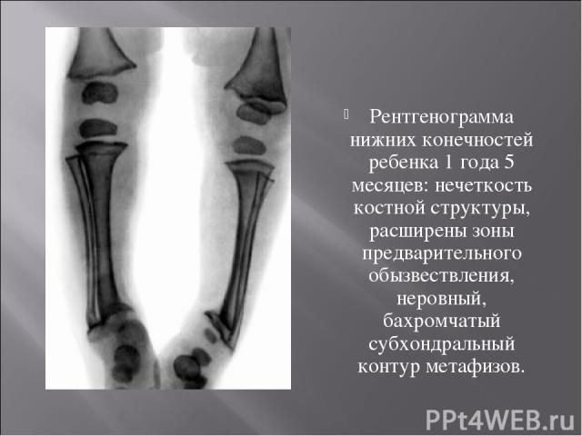 Рентгенограмма нижних конечностей ребенка 1 года 5 месяцев: нечеткость костной структуры, расширены зоны предварительного обызвествления, неровный, бахромчатый субхондральный контур метафизов.