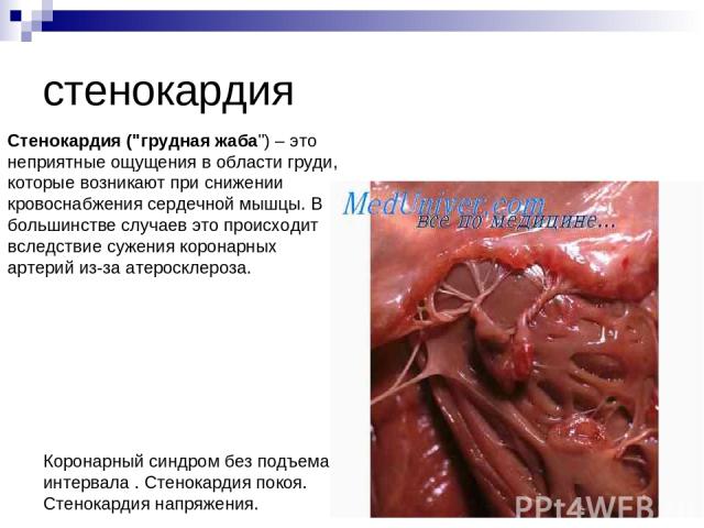 стенокардия Стенокардия (