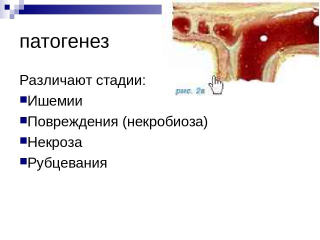 патогенез Различают стадии: Ишемии Повреждения (некробиоза) Некроза Рубцевания