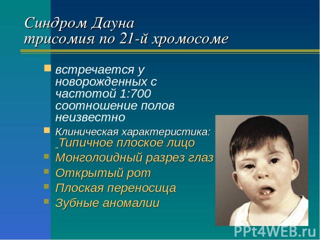 Синдром Дауна трисомия по 21-й хромосоме встречается у новорожденных с частотой 1:700 соотношение полов неизвестно Клиническая характеристика: Типичное плоское лицо Монголоидный разрез глаз Открытый рот Плоская переносица Зубные аномалии