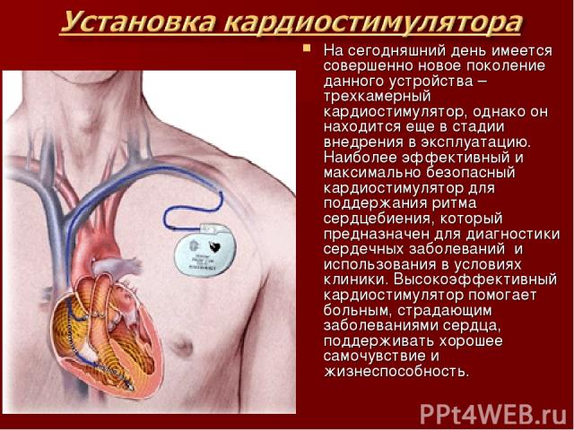 На сегодняшний день имеется совершенно новое поколение данного устройства – трехкамерный кардиостимулятор, однако он находится еще в стадии внедрения в эксплуатацию. Наиболее эффективный и максимально безопасный кардиостимулятор для поддержания ритм…