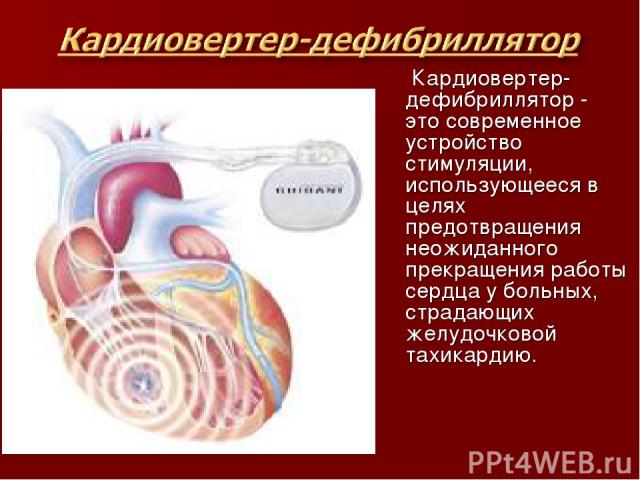 Кардиовертер-дефибриллятор - это современное устройство стимуляции, использующееся в целях предотвращения неожиданного прекращения работы сердца у больных, страдающих желудочковой тахикардию.