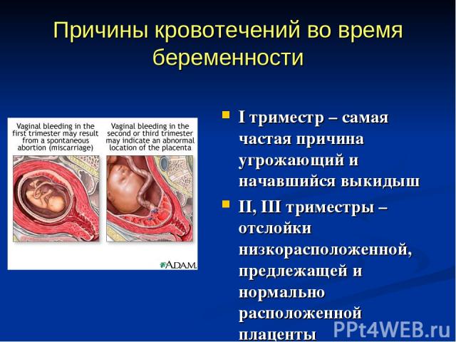 Причины кровотечений во время беременности I триместр – самая частая причина угрожающий и начавшийся выкидыш II, III триместры – отслойки низкорасположенной, предлежащей и нормально расположенной плаценты