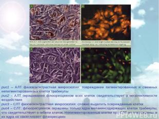 рис1 – АЛТ фазовоконтрастная микроскопия: повреждение пигментированных и смежных