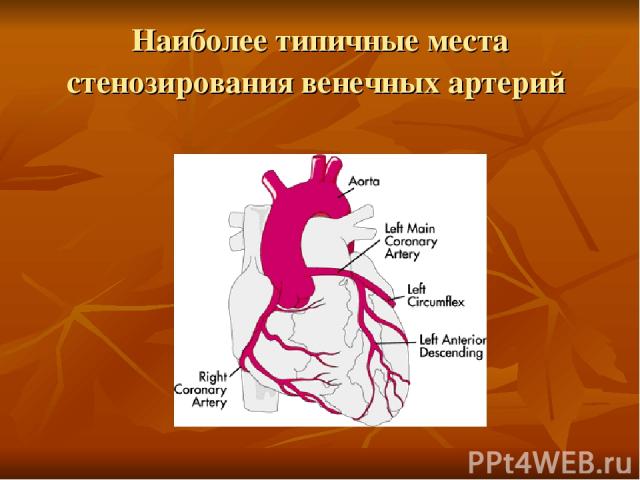 Наиболее типичные места стенозирования венечных артерий