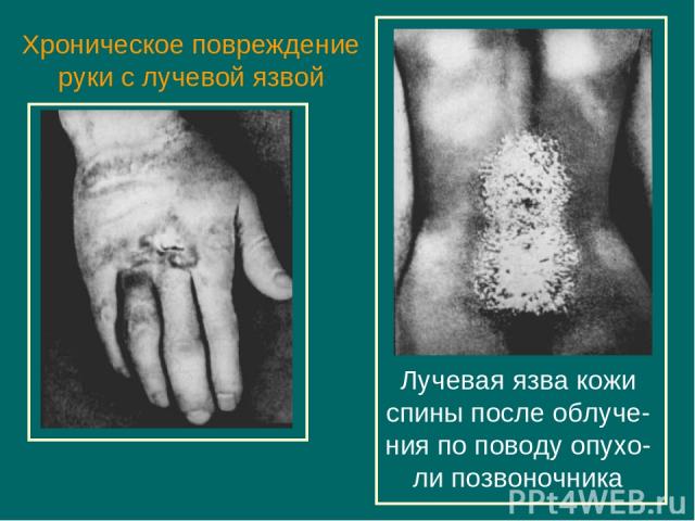 Хроническое повреждение руки с лучевой язвой Лучевая язва кожи спины после облуче-ния по поводу опухо-ли позвоночника