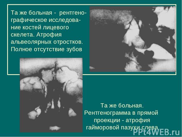 Та же больная - рентгено- графическое исследова-ние костей лицевого скелета. Атрофия альвеолярных отростков. Полное отсутствие зубов Та же больная. Рентгенограмма в прямой проекции - атрофия гайморовой пазухи слева