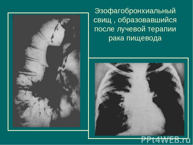 Эзофагобронхиальный свищ , образовавшийся после лучевой терапии рака пищевода