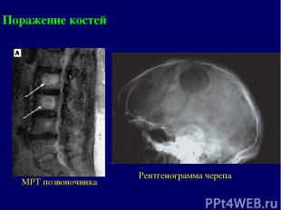 МРТ позвоночника Рентгенограмма черепа Поражение костей