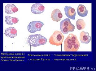 Миеломные клетки с кристализированным белком Бен-Джонса Миеломные клетки с тальц