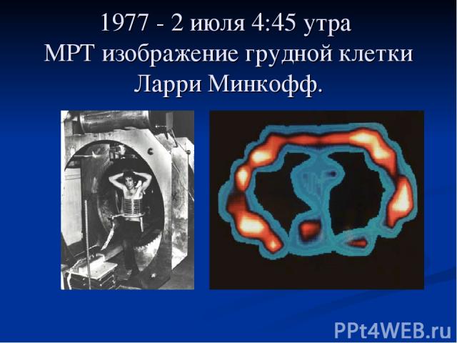 1977 - 2 июля 4:45 утра МРТ изображение грудной клетки Ларри Минкофф.