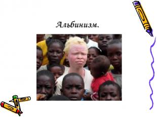 Альбинизм.