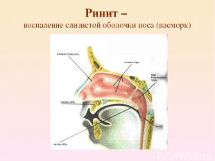 Ринит – воспаление слизистой оболочки носа (насморк)