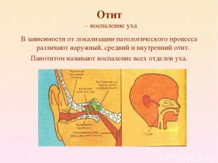 Отит – воспаление уха В зависимости от локализации патологического процесса разл