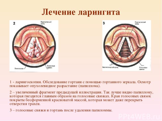 Лечение ларингита 1 - ларингоскопия. Обследование гортани с помощью гортанного зеркала. Осмотр показывает опухолевидное разрастание (папиллома). 2 – увеличенный фрагмент предыдущей иллюстрации. Так лучше видно папиллому, которая гнездится главным об…