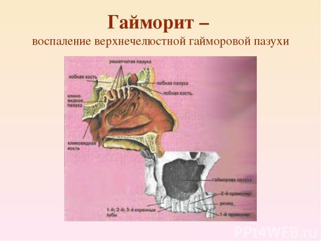 Гайморит – воспаление верхнечелюстной гайморовой пазухи