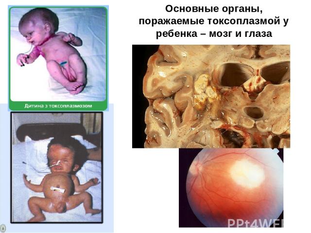 Основные органы, поражаемые токсоплазмой у ребенка – мозг и глаза