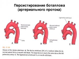 Персистирование боталлова (артериального протока)