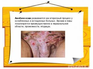 Амебиаз кожи развивается как вторичный процесс у ослабленных и истощенных больны