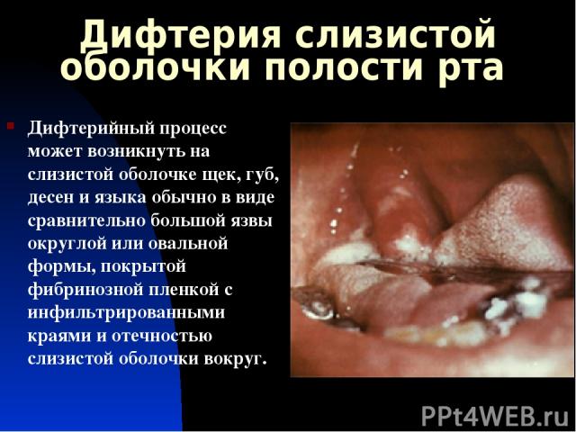 Дифтерия слизистой оболочки полости рта Дифтерийный процесс может возникнуть на слизистой оболочке щек, губ, десен и языка обычно в виде сравнительно большой язвы округлой или овальной формы, покрытой фибринозной пленкой с инфильтрированными краями …