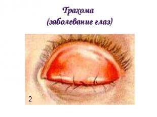 Трахома (заболевание глаз)