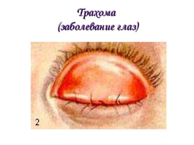 Трахома (заболевание глаз)