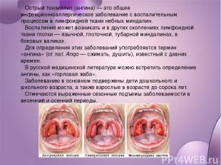 Острый тонзиллит (ангина) — это общее инфекционноаллергическое заболевание с вос