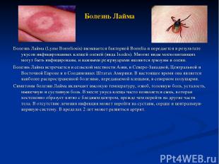 Болезнь Лайма Болезнь Лайма (Lyme Borreliosis) вызывается бактерией Borrelia и п