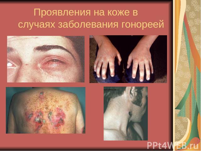 Проявления на коже в случаях заболевания гонореей