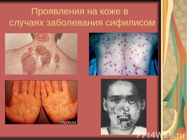 Проявления на коже в случаях заболевания сифилисом