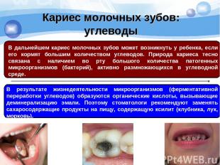 Кариес молочных зубов: углеводы В дальнейшем кариес молочных зубов может возникн