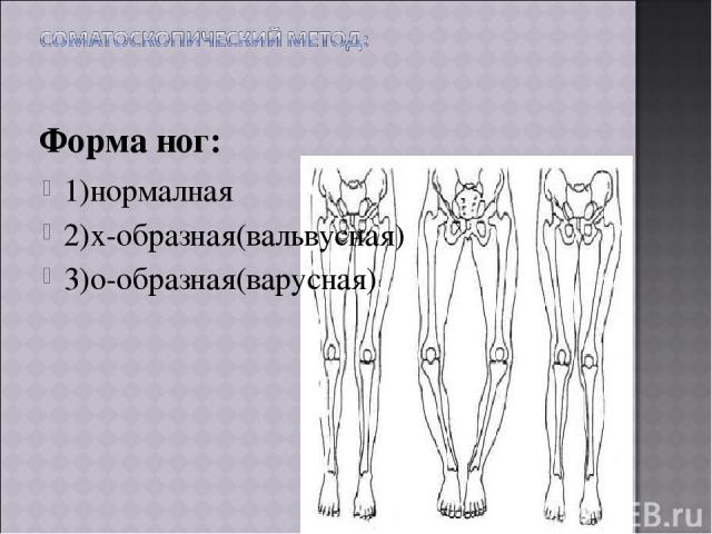Форма ног: 1)нормалная 2)х-образная(вальвусная) 3)о-образная(варусная)